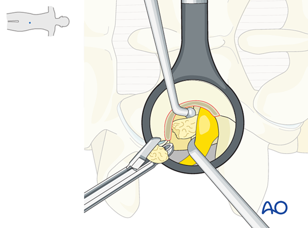 Removal of disc fragments during Extraforaminal microscopic tubular lumbar discectomy (EMTLD)