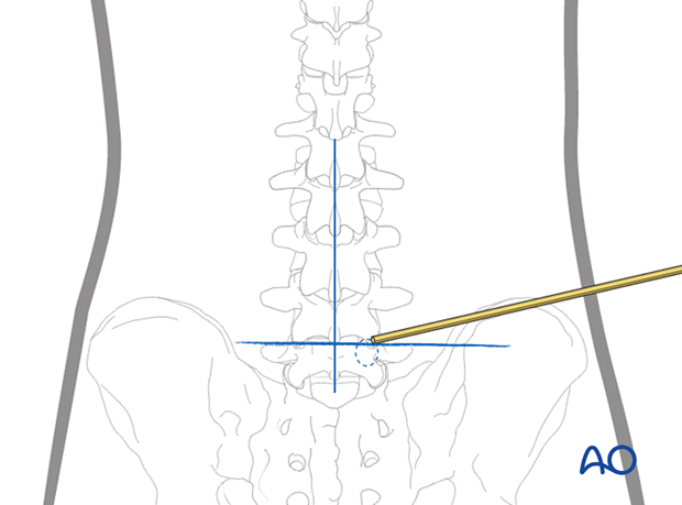 57b P320 Extraforaminal endoscopic lumbar discectomy EELD