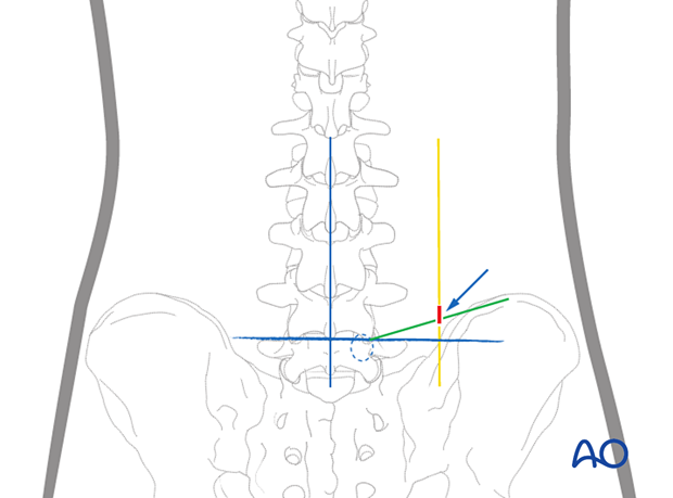 The location of the entry point during Extraforaminal endoscopic lumbar discectomy.