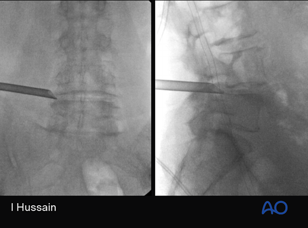 57b P320 Extraforaminal endoscopic lumbar discectomy EELD