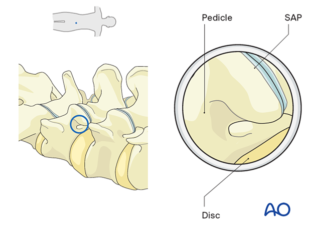 Visualizing the superior articular process (SAP) and the cranial aspect of the caudal pedicle during Extraforaminal endoscopic lumbar discectomy.