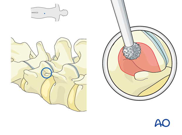 Using a burr to resect a portion of the superior articular process during an Extraforaminal endoscopic lumbar discectomy.