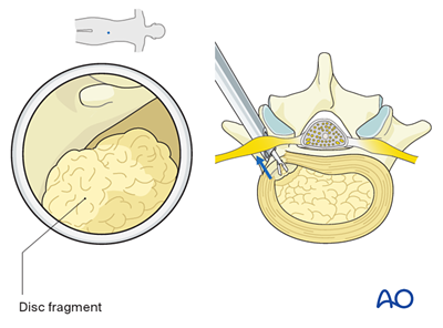 Extraforaminal endoscopic lumbar discectomy (EELD) for Lumbar disc ...