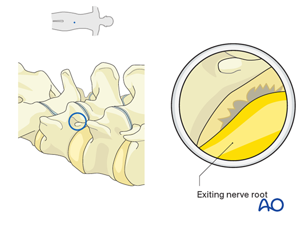 Identifying the exiting nerve root during an Extraforaminal endoscopic lumbar discectomy.