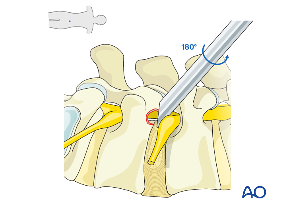 Extraforaminal Endoscopic Lumbar Discectomy (EELD) For Lumbar Disc ...