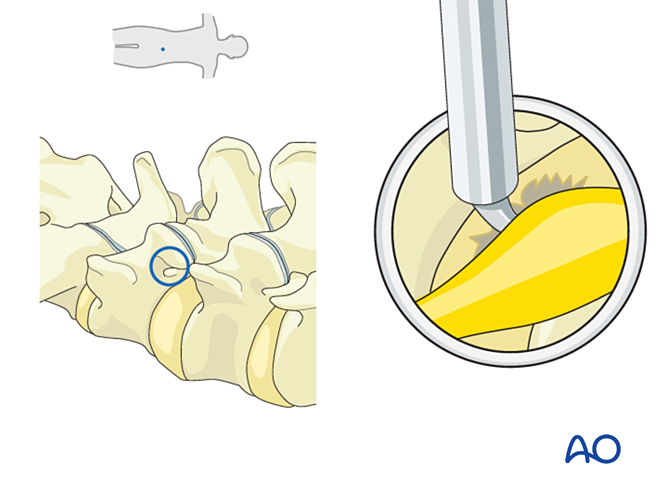 Extraforaminal endoscopic lumbar discectomy (EELD) for Lumbar disc ...