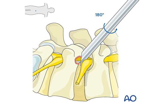 Rotating the working channel bevel 180° to protect the exiting nerve root during Transforaminal endoscopic lumbar discectomy (TELD)