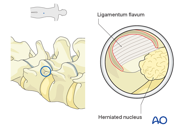A Kerrison rongeur can be used to resect the lateral aspect of the ligamentum flavum and identify the transversing nerve root during Transforaminal endoscopic lumbar discectomy (TELD)