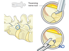 Removal of disc fragment during Transforaminal endoscopic lumbar discectomy (TELD)