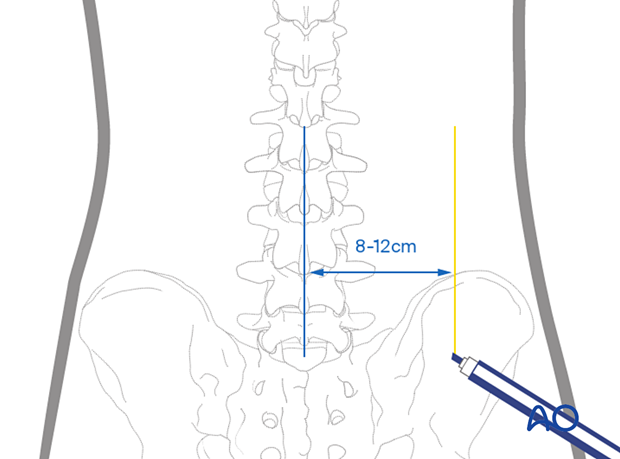 Drawing vertical planning lines during Transforaminal endoscopic lumbar discectomy (TELD)