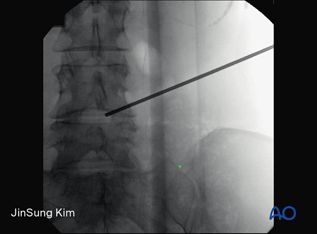 Placing a radio-opaque object with the tip at the intersection of the midline and horizontal markings during Transforaminal endoscopic lumbar discectomy (TELD)