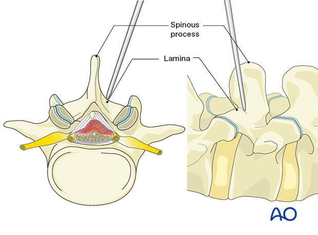 Insertion of the first dilator during minimally invasive surgery on the lumbar spine