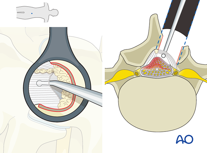 Microscopic tubular unilateral laminotomy for bilateral decompression ...