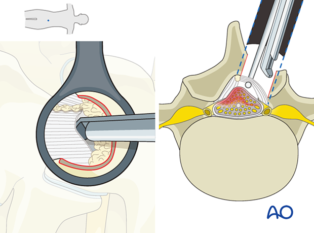 Using a Kerrison rongeur to resect the ipsilateral ligamentum flavum during Microscopic tubular unilateral laminotomy for bilateral decompression (MT-ULBD)