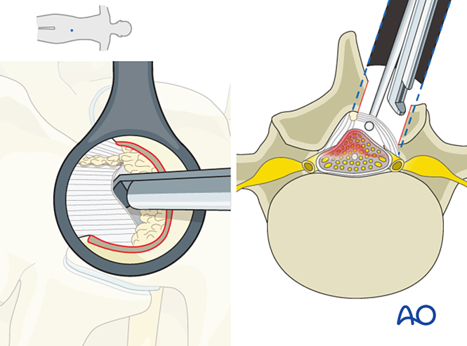 Microscopic tubular unilateral laminotomy for bilateral decompression ...