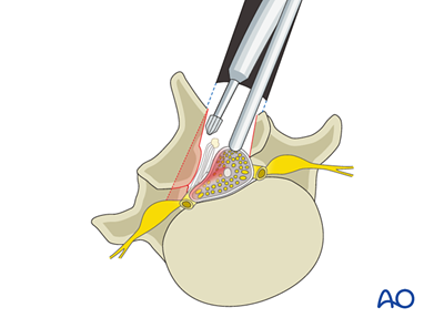 Microscopic tubular unilateral laminotomy for bilateral decompression ...