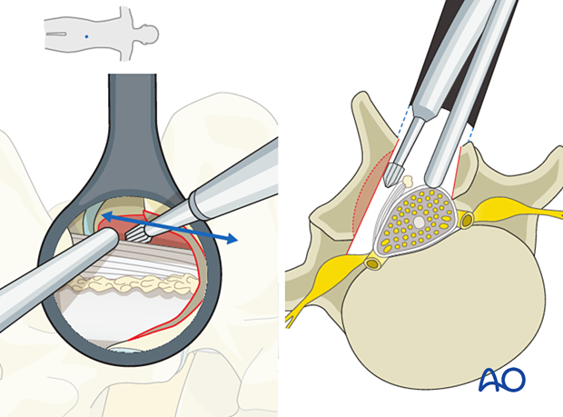 Drilling to expose the entirety of the contralateral ligamentum flavum during Microscopic tubular unilateral laminotomy for bilateral decompression (MT-ULBD)