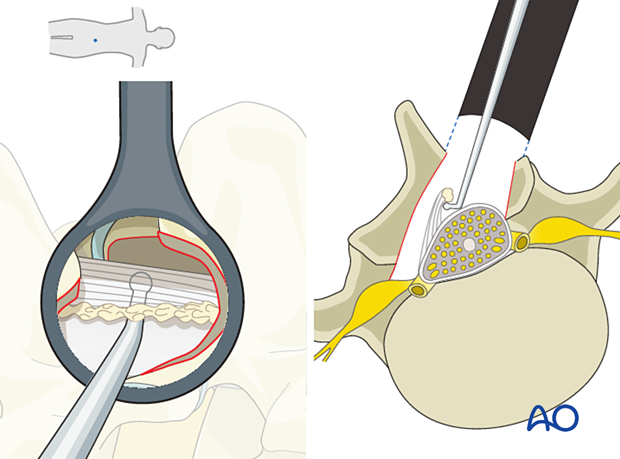 57b P510 Microscopic tubular unilateral laminotomy for bilateral decompression MT-ULBD
