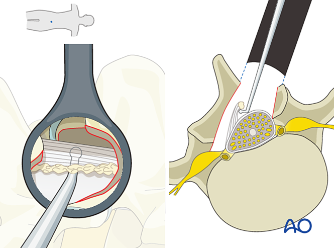 Microscopic tubular unilateral laminotomy for bilateral decompression ...