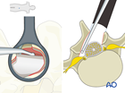 Microscopic tubular unilateral laminotomy for bilateral decompression (MT-ULBD)