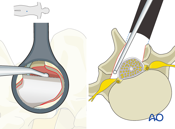 Microscopic tubular unilateral laminotomy for bilateral decompression ...