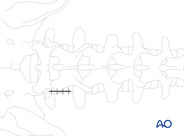 Tube removal and closure during minimally invasive surgery on the lumbar spine.