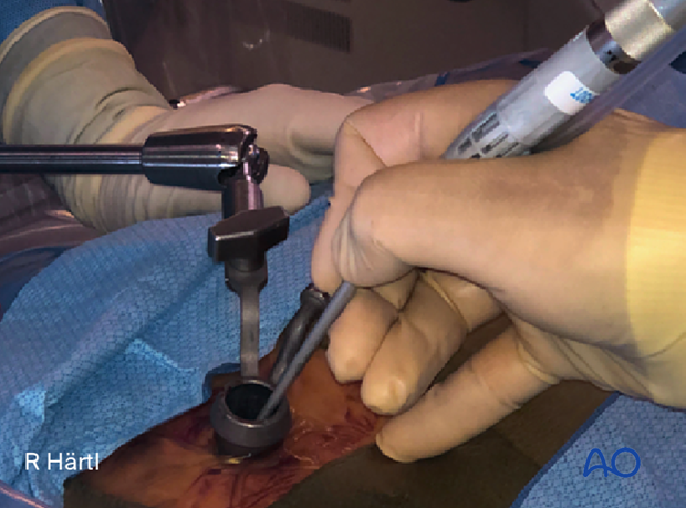 Using instruments safely through the tubular retractor during minimally invasive spine surgery.