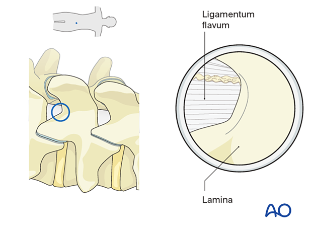 The ligamentum flavum and the inferior medial edge of the lamina are identified during Lumbar endoscopic unilateral laminotomy for bilateral decompression (LE-ULBD)