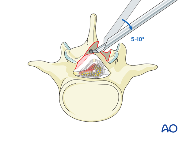 The working channel may have to be angled 5°–10° medially to facilitate contralateral decompression during Lumbar endoscopic unilateral laminotomy for bilateral decompression (LE-ULBD).