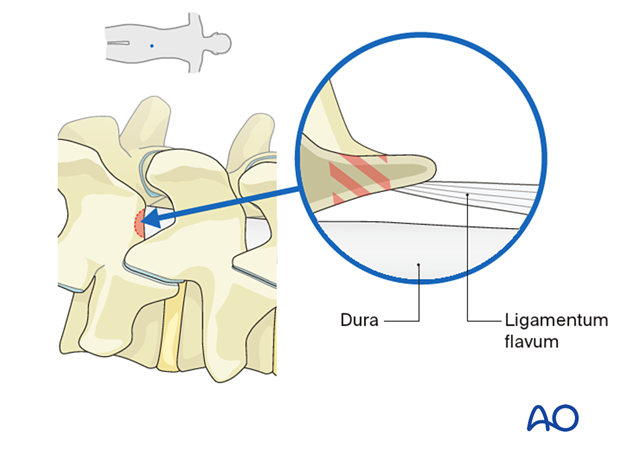 While doing the caudal laminotomy, care must be taken as there may not be underlying ligamentum flavum protecting the dura during Lumbar endoscopic unilateral laminotomy for bilateral decompression (LE-ULBD).