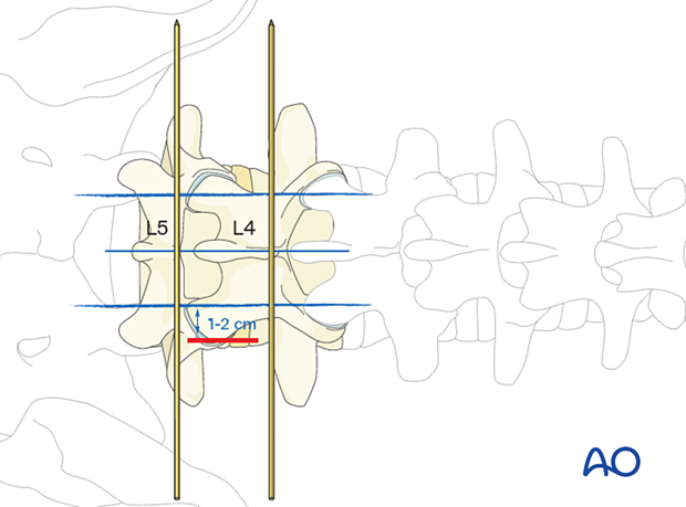 Marking of the incision site during MISS Transforaminal lumbar interbody fusion (TLIF)