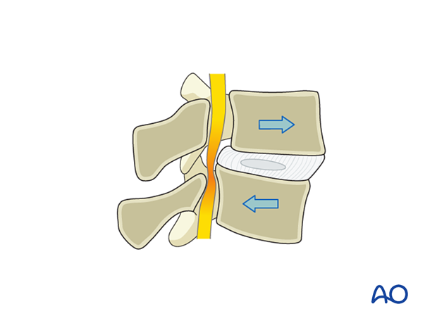 Lumbar spinal stenosis with spondylolisthesis