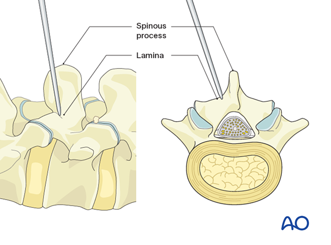 MISS Transforaminal lumbar interbody fusion (TLIF) for Lumbar spinal ...