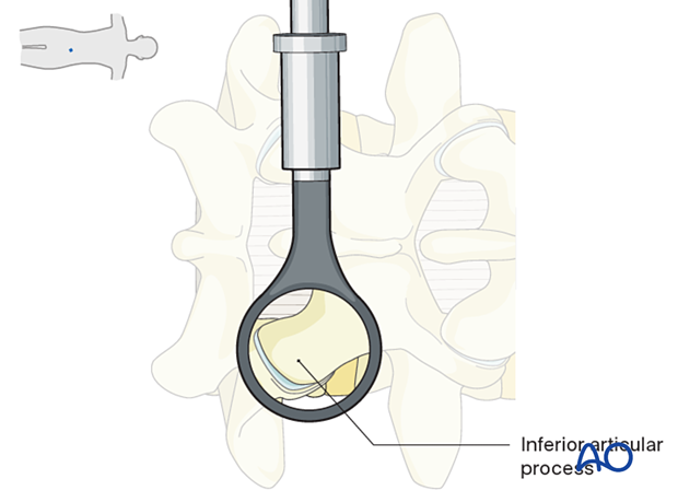 Visualizing the inferior articular process during MISS Transforaminal lumbar interbody fusion (TLIF)