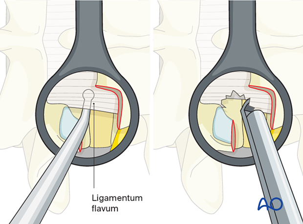 Resection of the ligamentum flavum during MISS Transforaminal lumbar interbody fusion (TLIF)