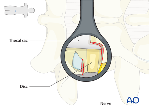 Visualizing the disc during MISS Transforaminal lumbar interbody fusion (TLIF)