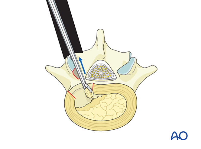 MISS Transforaminal lumbar interbody fusion (TLIF) for Degenerative ...