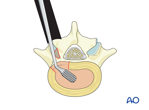 Removing the cartilage from the vertebral endplates during MISS Transforaminal lumbar interbody fusion (TLIF)