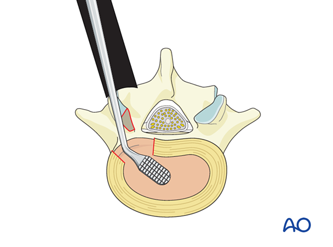 MISS Transforaminal lumbar interbody fusion (TLIF) for Degenerative ...