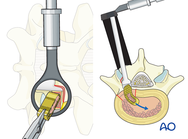 Positioning an implant in the discectomy space during MISS Transforaminal lumbar interbody fusion (TLIF)