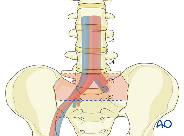 Anterior lumbar interbody fusion (ALIF) is the best approach for level L5–S1. It can be used at L4–L5 and L3–L4 but is technically more difficult.