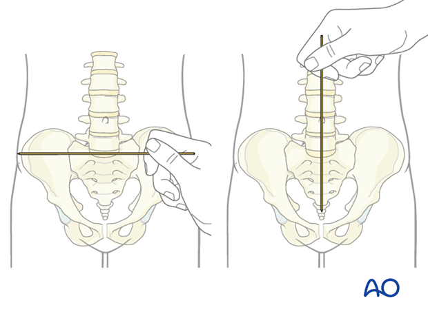 It is helpful to use a localizer on the skin to identify the level and the incision position during Anterior lumbar interbody fusion (ALIF).