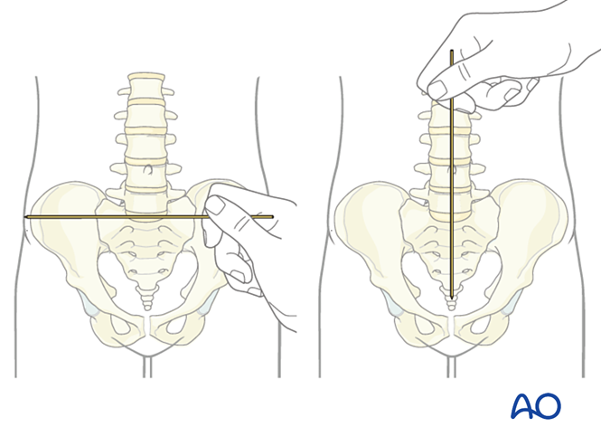 Anterior lumbar interbody fusion (ALIF) for Degenerative spondylolisthesis