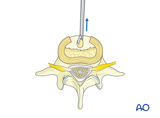 During Anterior Lumbar Interbody Fusion (ALIF) disc is removed down to the subcentral bone