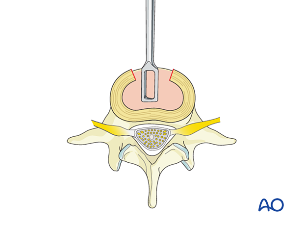 During Anterior Lumbar Interbody Fusion (ALIF), the entire nucleus pulposus and all the cartilage are removed from the endplates