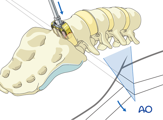 During Anterior Lumbar Interbody Fusion (ALIF), breaking the operative table increases the lordotic configuration. The cage is then inserted.