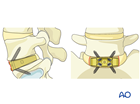 Cage in position with screws attached during Anterior lumbar interbody fusion (ALIF)