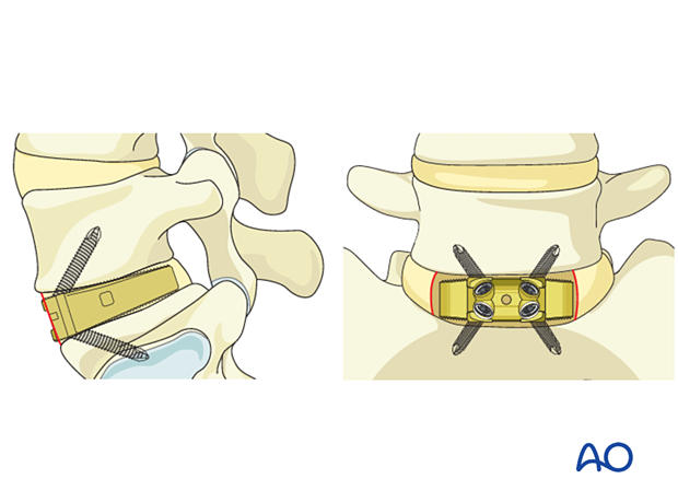 A set of anchors or screws can be attached, ensuring sound fixation and stabilization during Anterior Lumbar Interbody Fusion (ALIF)