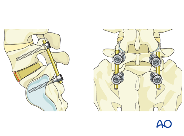 Additional fixation is recommended if stand-alone cages are used during Anterior Lumbar Interbody Fusion (ALIF)