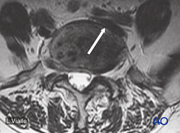 MRI scan at the level of the lumbar spine to identify the iliac veins